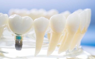 ¿Qué son los Implantes Dentales?. Resolvemos las dudas más frecuentes