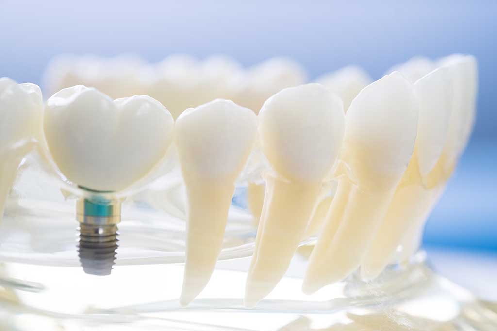 Qué son los Implantes Dentales. Clínica de Implantología dental en Albacete y Madrid