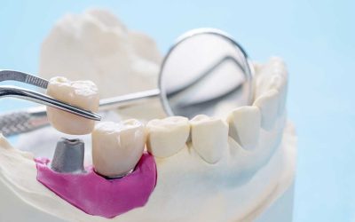 Cómo alargar la vida de tus implantes dentales