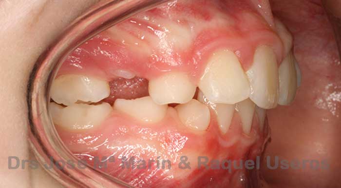 Caso de Éxito en Ortodoncia Rodrigo Lateral izquierdo FinalCaso de Éxito en Ortodoncia Rodrigo Lateral izquierdo Final