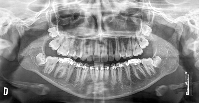 Caso de Éxito en Ortodoncia Rodrigo Lateral izquierdo FinalCaso de Éxito en Ortodoncia Rodrigo Oclusal Arriba Final